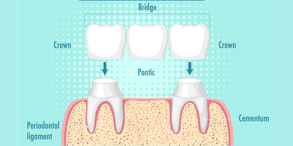 Crown & Bridges