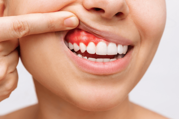 Gums Treatment