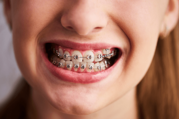 Orthodontic treatment