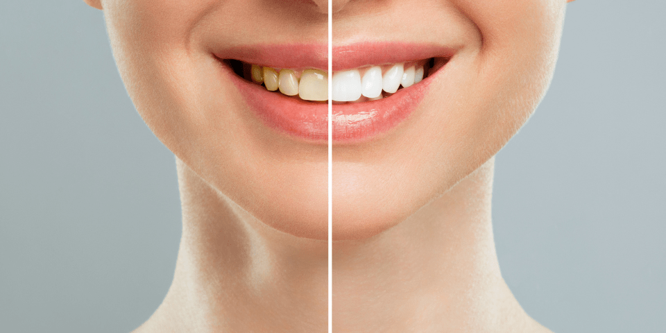 Smile Makeover