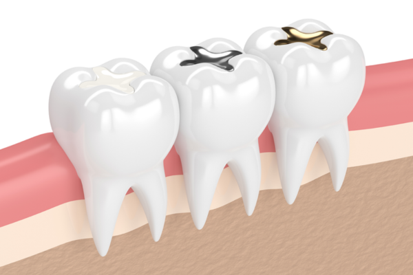 Tooth Color Fillings