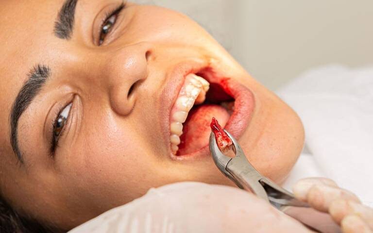 What To Do and What Not To Do After Wisdom Teeth Removal(Extraction)