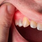 Explore The Dangers Of Untreated Gum Disease