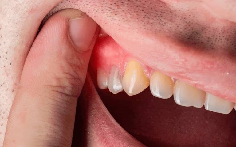 Explore the Dangers of untreated Gum Disease